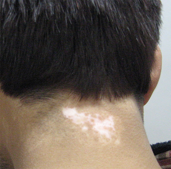 White Spots - Leucoderma | Shah Skin - Cosmetic & Laser Centre